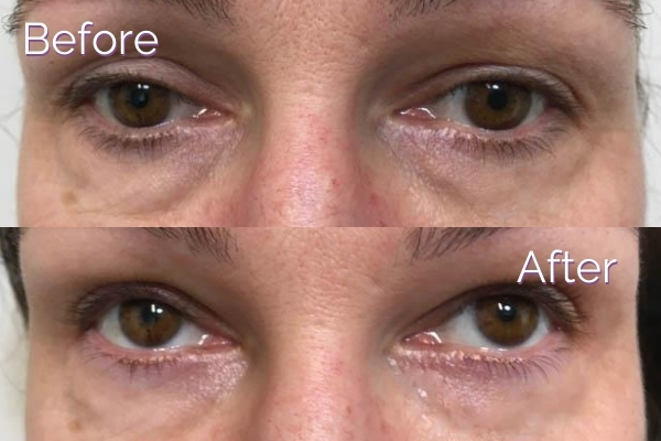 Laser Treatment for Dark Circles Under Eyes | Dr. Prasad Blog