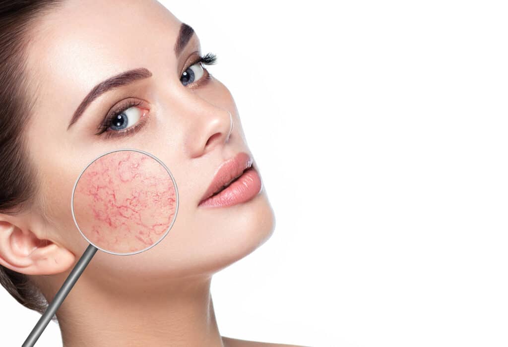 Rosacea Treatment