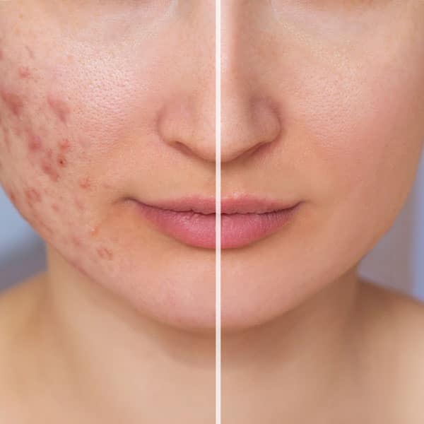 before after acne treatment